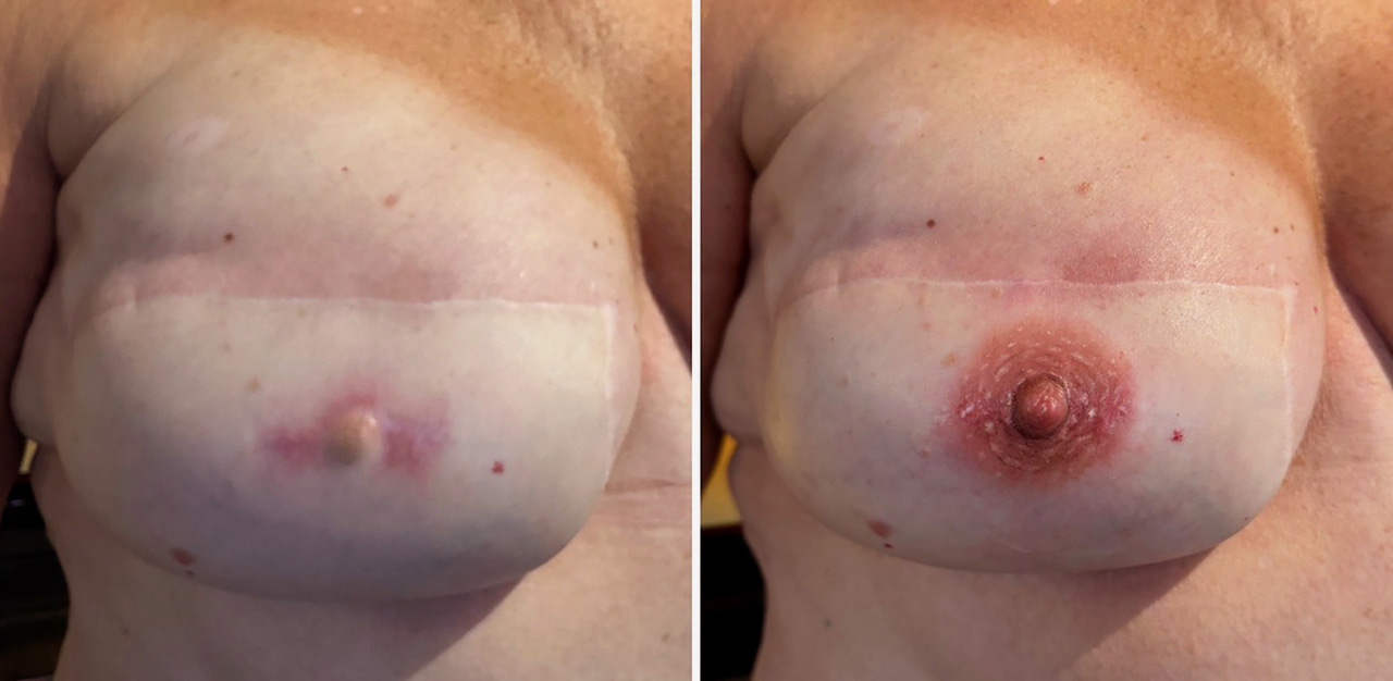 Areola and Nipple tattoo Reconstruction